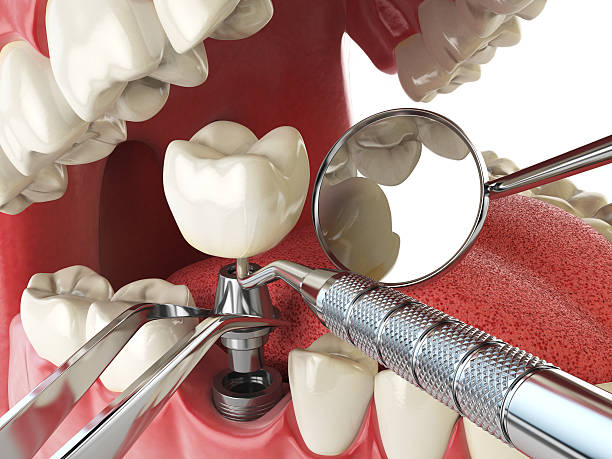 Best Broken or Chipped Tooth Repair in Algonquin, IL